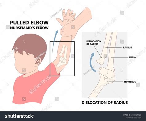 Nursemaid Wrist Pain at Susan Cochrane blog
