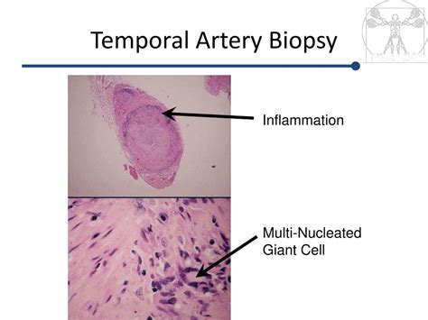 PPT - Vasculitis: Classification and Clinical Manifestations PowerPoint ...