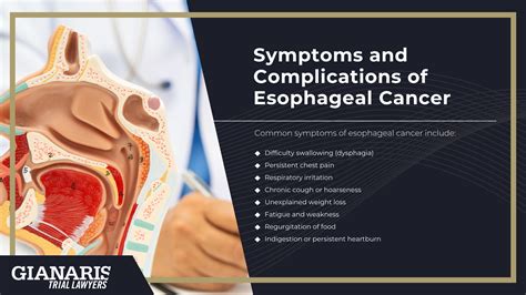 Railroad Esophageal Cancer Lawsuit [2026 Update]