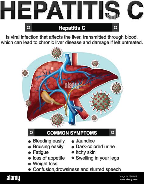 Hepatitis C Symptoms And Signs