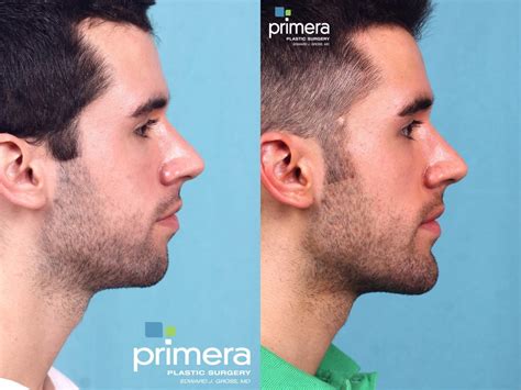 Surgery for Men Before and After Pictures Case 361 | Orlando, Winter Park & Tampa, Florida ...