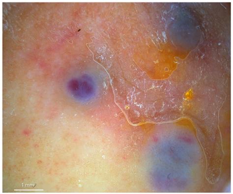 Non-Invasive Diagnostic Imaging in Kaposi Sarcoma Evaluation