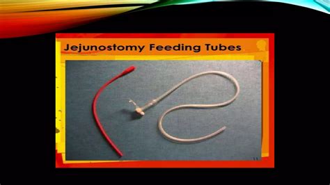 presentation on gastrostomy and jejunostomy feeding | PPTX