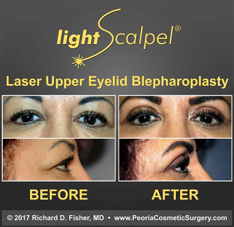 Unveil the Secrets of Eye Laser Surgery Recovery: Discoveries and Insights to Guide You - sampeo