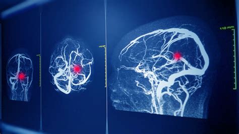 What You Need to Know about Brain Aneurysms