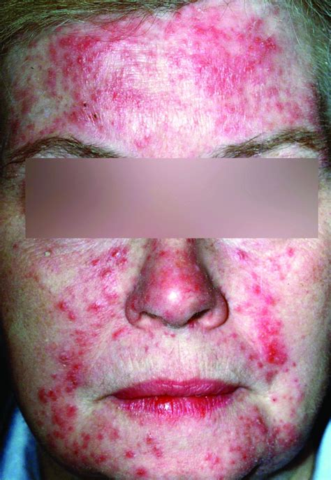 Cream For Rosacea Pustules at Charlotte Stretton blog