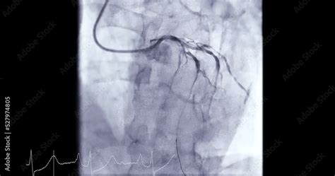 Coronary Angiogram Procedure 的图像结果