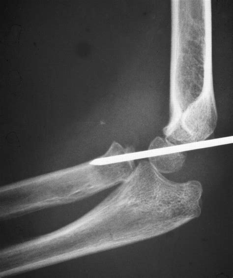 Open reduction, ulnar osteotomy and external fixation for chronic ...