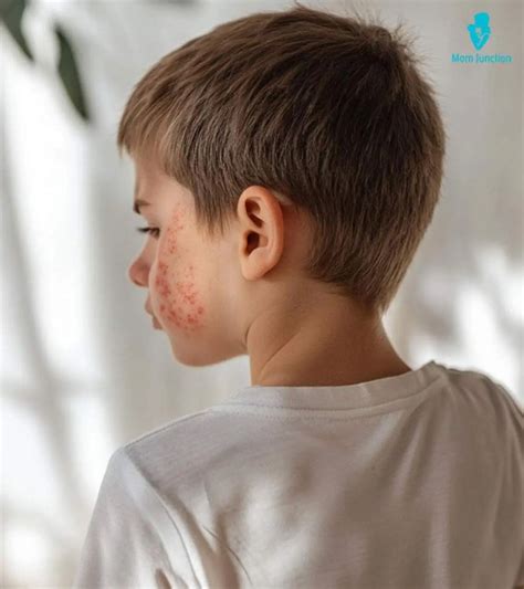 Fifth Disease In Children: Symptoms, Treatment & Prevention
