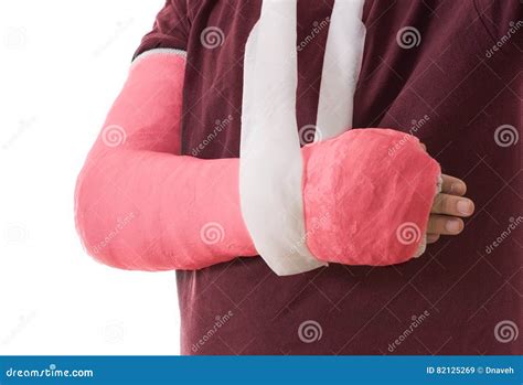 Broken Arm in Red Plaster Cast and Sling Stock Image - Image of injured ...