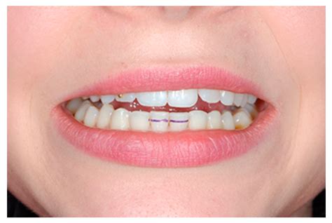 Diagnostic of Temporomandibular Disorders and Other Facial Pain ...
