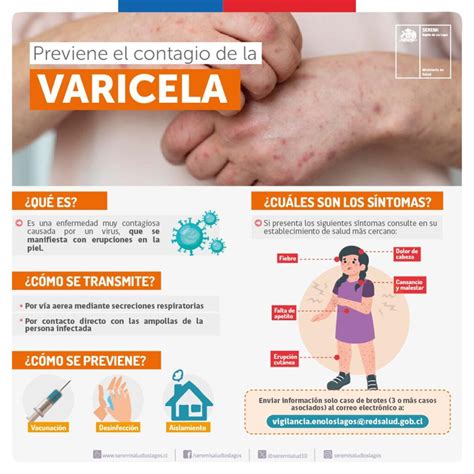 ¿Qué hacer si tu hijo tiene varicela? Conoce los síntomas y los cuidados necesarios – ChiloeNews