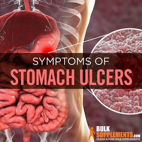 Stomach Ulcers: Causes, Symptoms, and Treatment