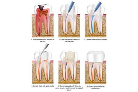 Root Canal Treatment Clinic Calicut | Best Dental Clinic Kozhikode