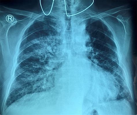 Severe mitral regurgitation causing unilateral pulmonary edema: A case ...