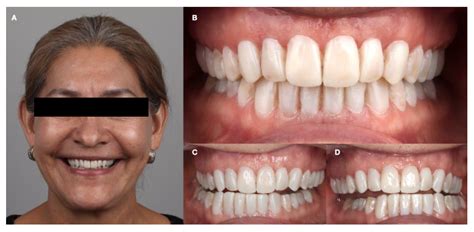 Combining Orthodontic and Restorative Care with Novel Workflows