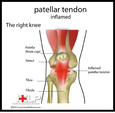 Patellar Tendon Inflamed | Knee pain relief, Knee pain, Knee injury