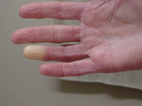 Types of Raynaud's Syndrome and How They Are Treated