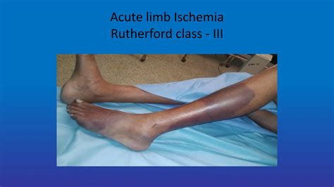 Diagnosis and management of Acute limb -ischemia (1).ppt