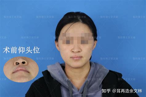 【案例分析】20岁女孩做鼻畸形修复术，恢复自然立体的鼻子 - 知乎