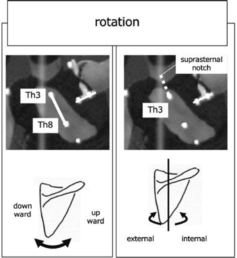 Image result for Scapular Rotation Dysfunction