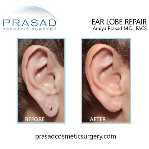 Can Stretched or Torn Earlobes be Repaired? - Dr. Prasad Blog