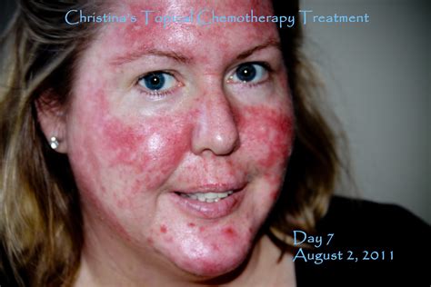 My Journey Through Topical Chemotherapy - Fluorouracil 5% Cream and Carac .5% Fluorouracil Cream ...