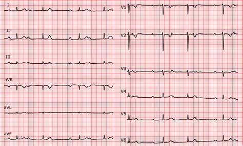Prepare For Medical Exams Wenckebach Or Type I Second Degree Av Block ...