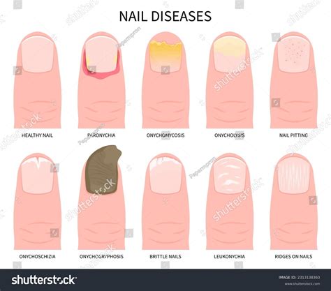 Zinc Deficiency Nails