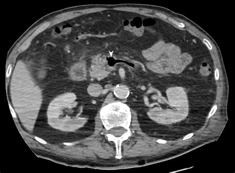 Septic thrombophlebitis of the portal vein: A life-threatening complication of diverticulitis ...