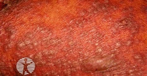 Rash Pictures SJS 的图像结果