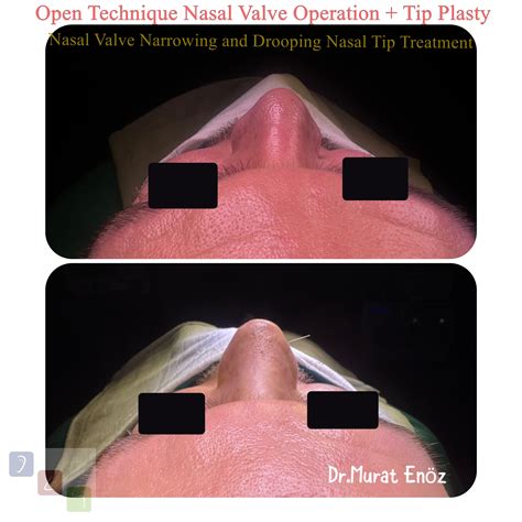 Nasal Valve Collapse and Treatment