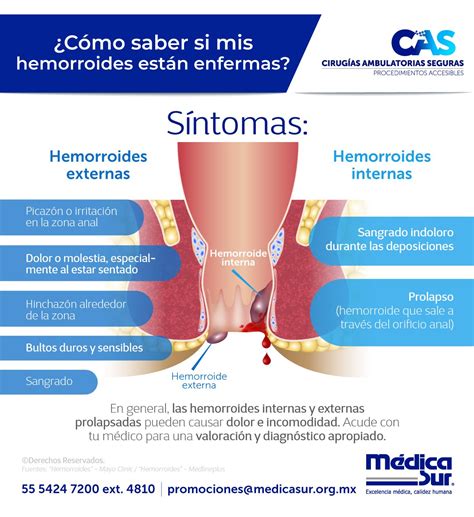 Hemorroides Internas Sintomas