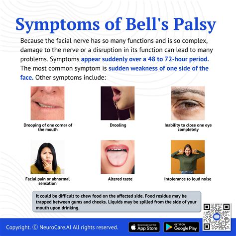 Bell's Palsy (The Basics)
