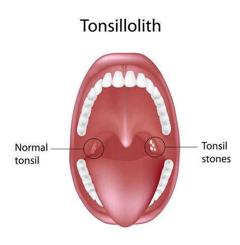 tonsil-stones - Pediatric Pulmonologists