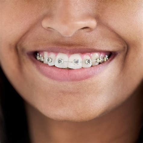 Image result for braces