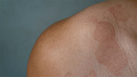 How Can You Prevent Tinea Infections?
