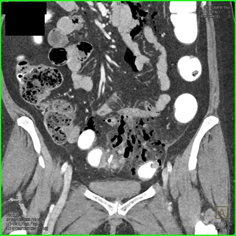 Bildergebnis für ruptured abscess on colon