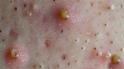 Largest Exploding Cyst 的图像结果
