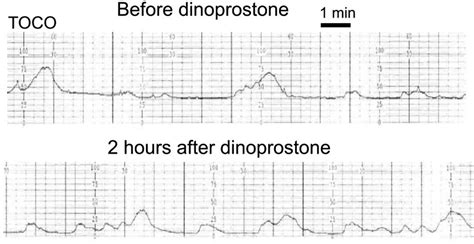 Monitoring uterine contractions during labor: current challenges and future directions ...