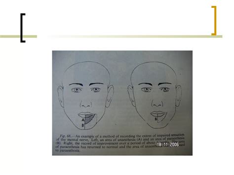 Local Anesthesia 的图像结果