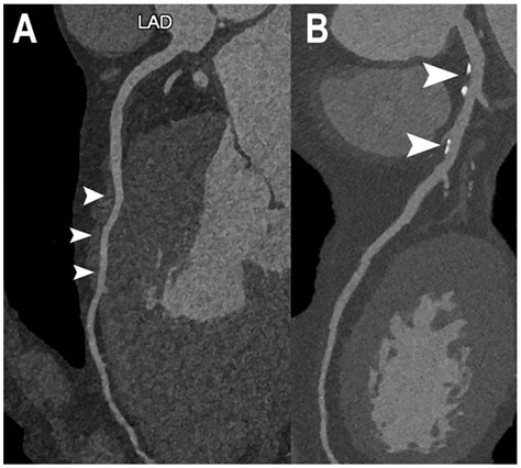 Dual-Source Photon-Counting Computed Tomography—Part I: Clinical ...