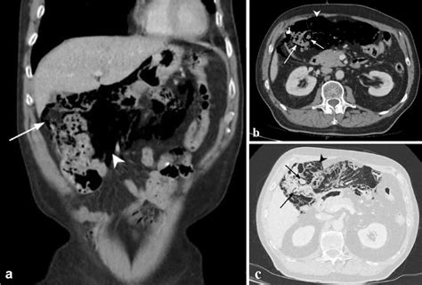 Pneumatosis Cystoides Intestinalis