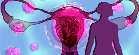 Ovarian Cancer | Research Matters