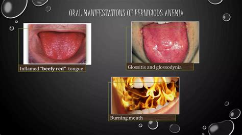 Oral manifestations of gastrointestinal disorders.ppt