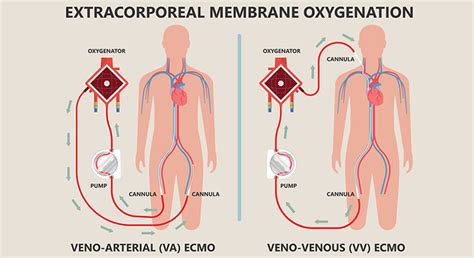 Image result for ECMO Procedure