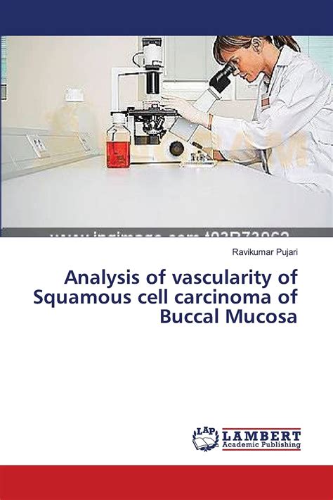 Buy Analysis of vascularity of Squamous cell carcinoma of Buccal Mucosa ...