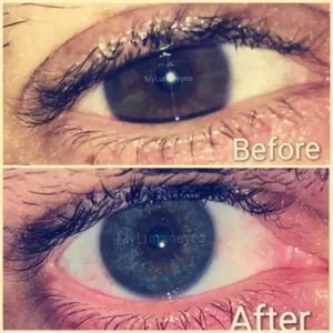 Image result for Eye Color Change Procedure