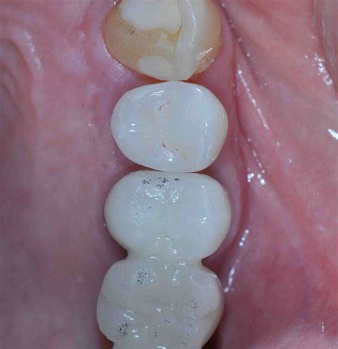 Tooth Crown Cement 的图像结果