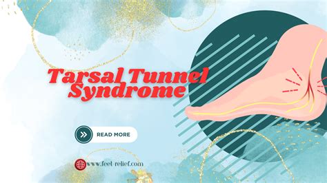 Tarsal Tunnel Syndrome, Prevention and Treatment - Feet Relief - tarsal tunnel syndrome treatments